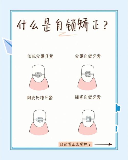 自锁矫正牙齿的原理是什么?如何实现牙齿移动?-图1 自锁矫正牙齿的原理是什么?如何实现牙齿移动?-图1