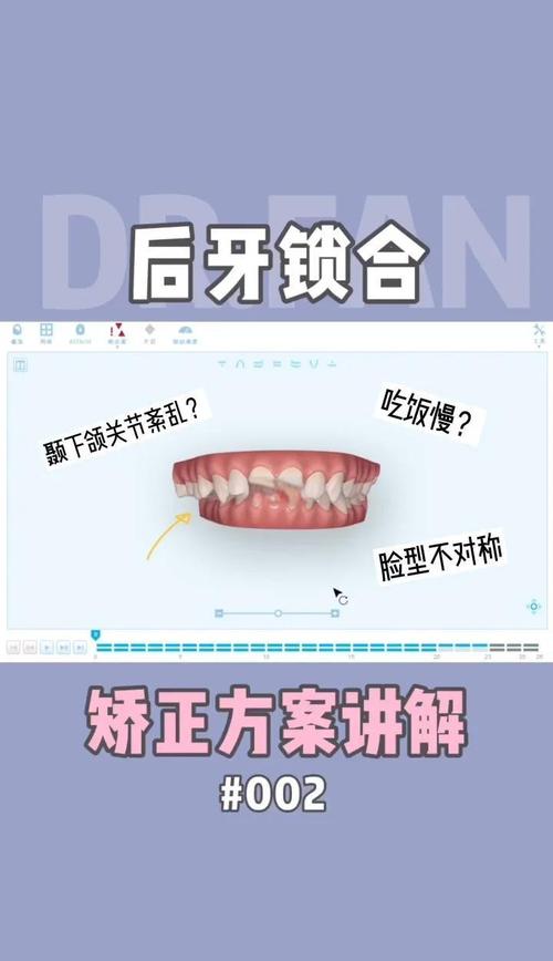 自锁矫正牙齿的原理是什么?如何实现牙齿移动?-图2 自锁矫正牙齿的原理是什么?如何实现牙齿移动?-图2