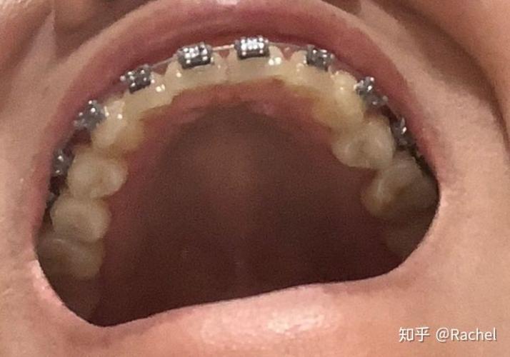 牙齿矫正单侧拔牙可行吗?会对咬合和脸型产生什么影响?-图2 牙齿矫正单侧拔牙可行吗?会对咬合和脸型产生什么影响?-图2
