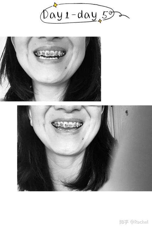 牙齿矫正单侧拔牙可行吗?会对咬合和脸型产生什么影响?-图3 牙齿矫正单侧拔牙可行吗?会对咬合和脸型产生什么影响?-图3