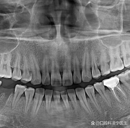 矫正牙齿拍什么片？不同片子有何作用？-图2