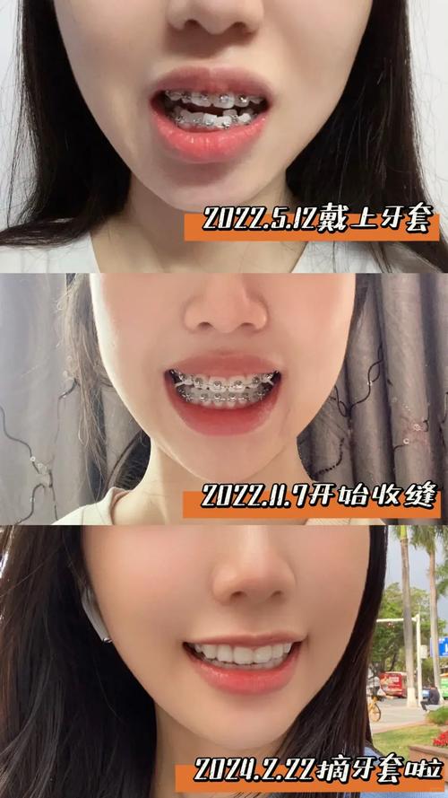 30岁矫正牙齿还来得及吗？效果会比年轻人差多少？-图2