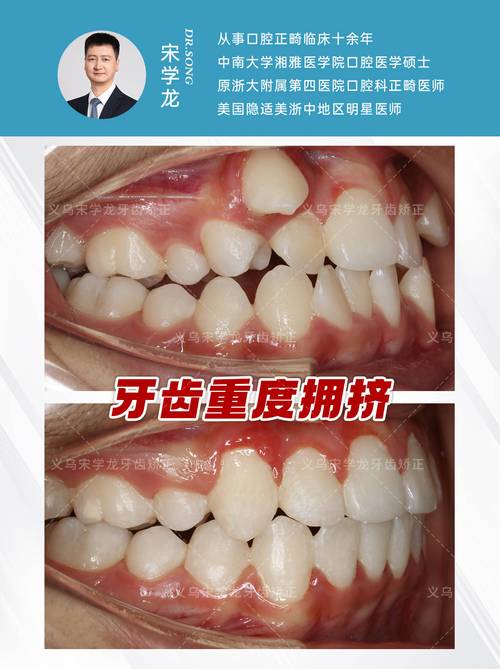 牙齿矫正如今普遍吗?矫正人群为何越来越多?-图2 牙齿矫正如今普遍吗?矫正人群为何越来越多?-图2