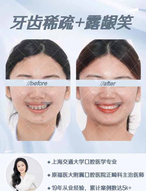 牙齿稀疏缝大矫正后,缝隙能完全消失吗?-图1 牙齿稀疏缝大矫正后,缝隙能完全消失吗?-图1