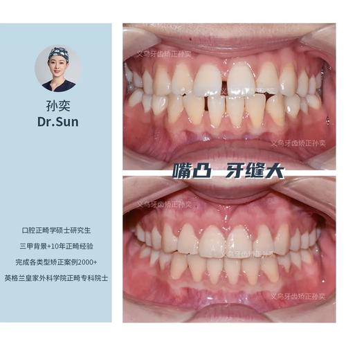牙齿稀疏缝大矫正后,缝隙能完全消失吗?-图2 牙齿稀疏缝大矫正后,缝隙能完全消失吗?-图2