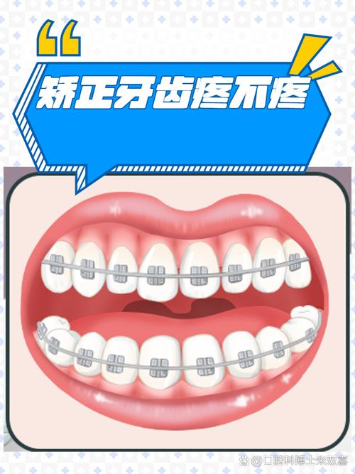 矫正牙齿加力疼不疼?加力后的疼痛感有多强?-图1 矫正牙齿加力疼不疼?加力后的疼痛感有多强?-图1