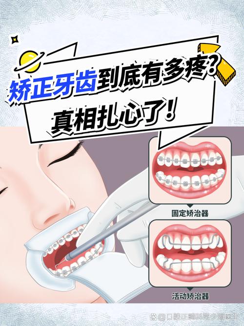 矫正牙齿加力疼不疼?加力后的疼痛感有多强?-图2 矫正牙齿加力疼不疼?加力后的疼痛感有多强?-图2