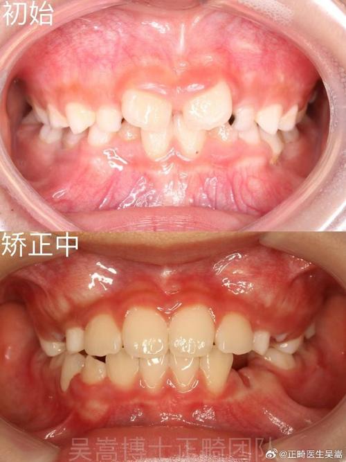 矫正牙齿后牙缝不闭合？原因何在？该如何处理？-图3
