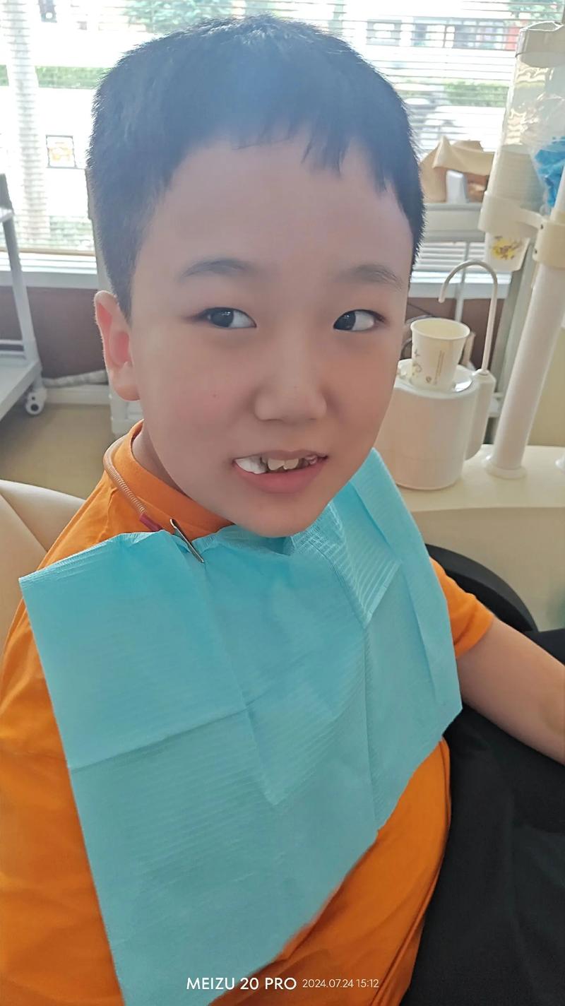 男孩牙齿矫正拔牙-图1 男孩牙齿矫正拔牙-图1