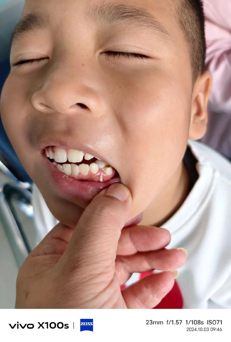 男孩牙齿矫正拔牙-图2 男孩牙齿矫正拔牙-图2