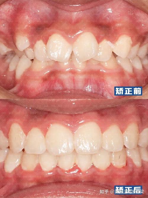 北京通州牙齿矫正哪家好？价格效果怎么样？-图3