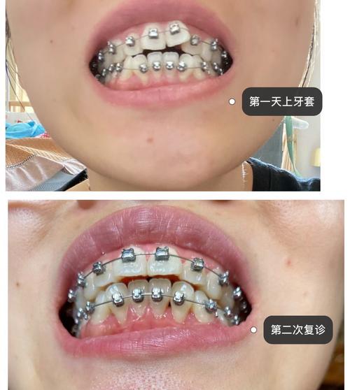 矫正牙齿是什么感觉？全程疼不疼，酸胀吗？-图3