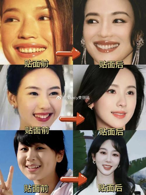 明星矫正牙齿前后反差有多大?效果惊艳还是另有隐情?-图1 明星矫正牙齿前后反差有多大?效果惊艳还是另有隐情?-图1