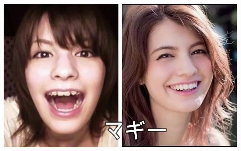 明星矫正牙齿前后反差有多大?效果惊艳还是另有隐情?-图3 明星矫正牙齿前后反差有多大?效果惊艳还是另有隐情?-图3