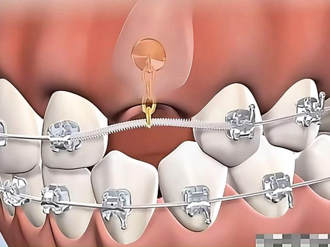 北京牙齿矫正分期怎么选？费用和流程有哪些？-图1
