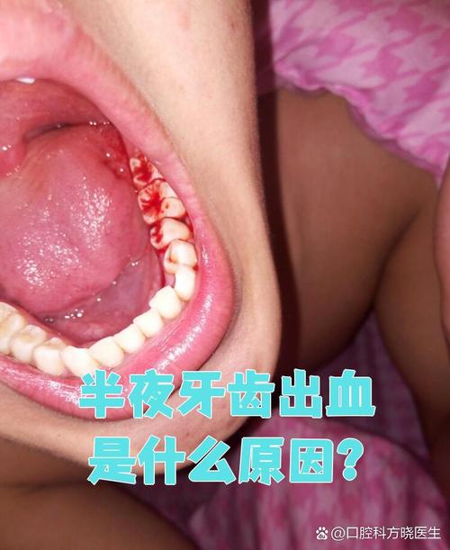 矫正牙齿牙龈出血，是正常现象吗？-图3