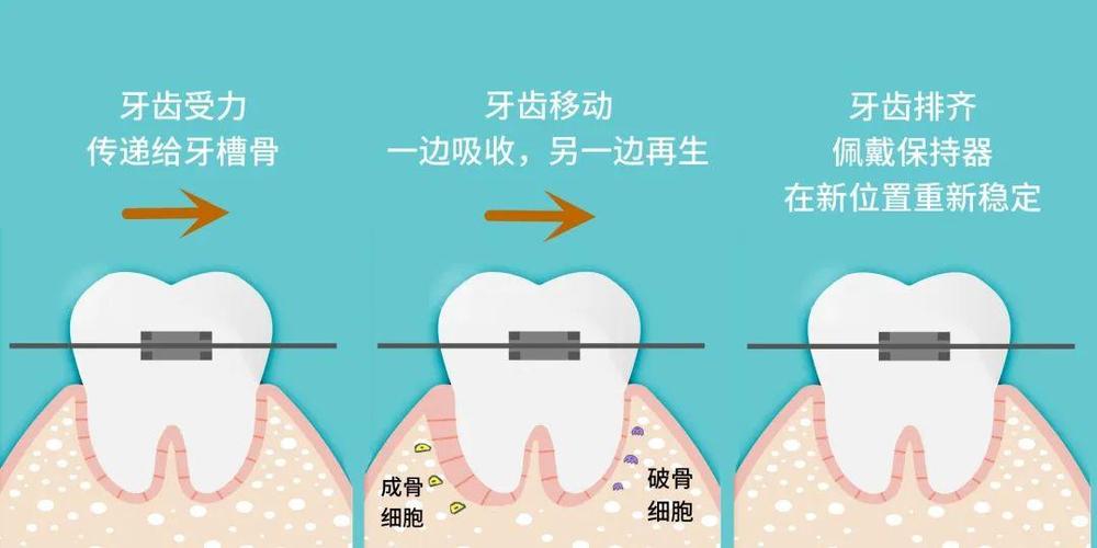 牙齿突出矫正的原理是什么？牙齿如何被移动矫正？-图2