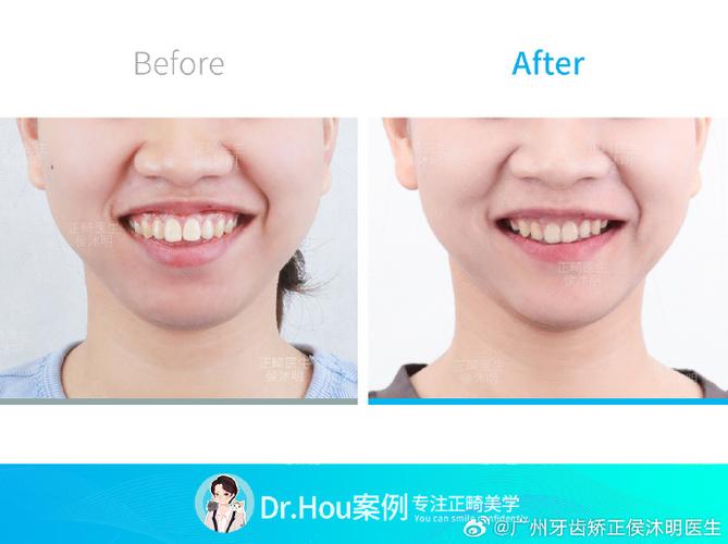 广州快速矫正牙齿靠谱吗？效果多久能见？安全有保障吗？-图2