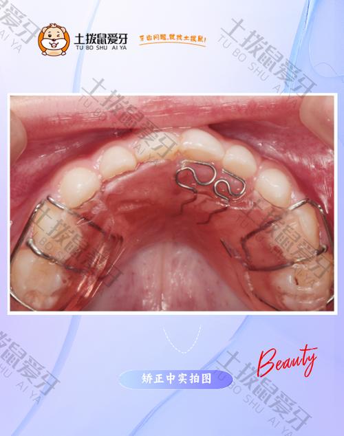 矫正牙齿为什么要上弹簧？它到底有啥用？-图1