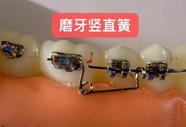 矫正牙齿为什么要上弹簧？它到底有啥用？-图2
