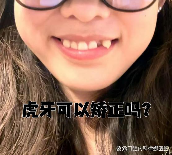 不拔虎牙矫正牙齿,效果与美观能兼顾吗?-图1 不拔虎牙矫正牙齿,效果与美观能兼顾吗?-图1