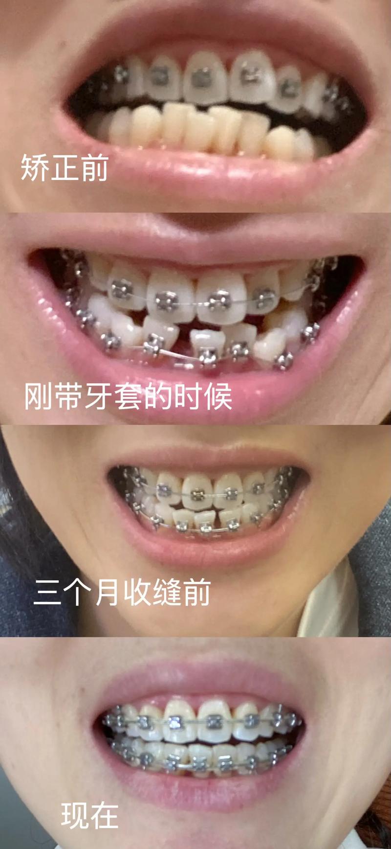 成人矫正牙齿好吗？效果、时间、风险该了解清楚？-图3