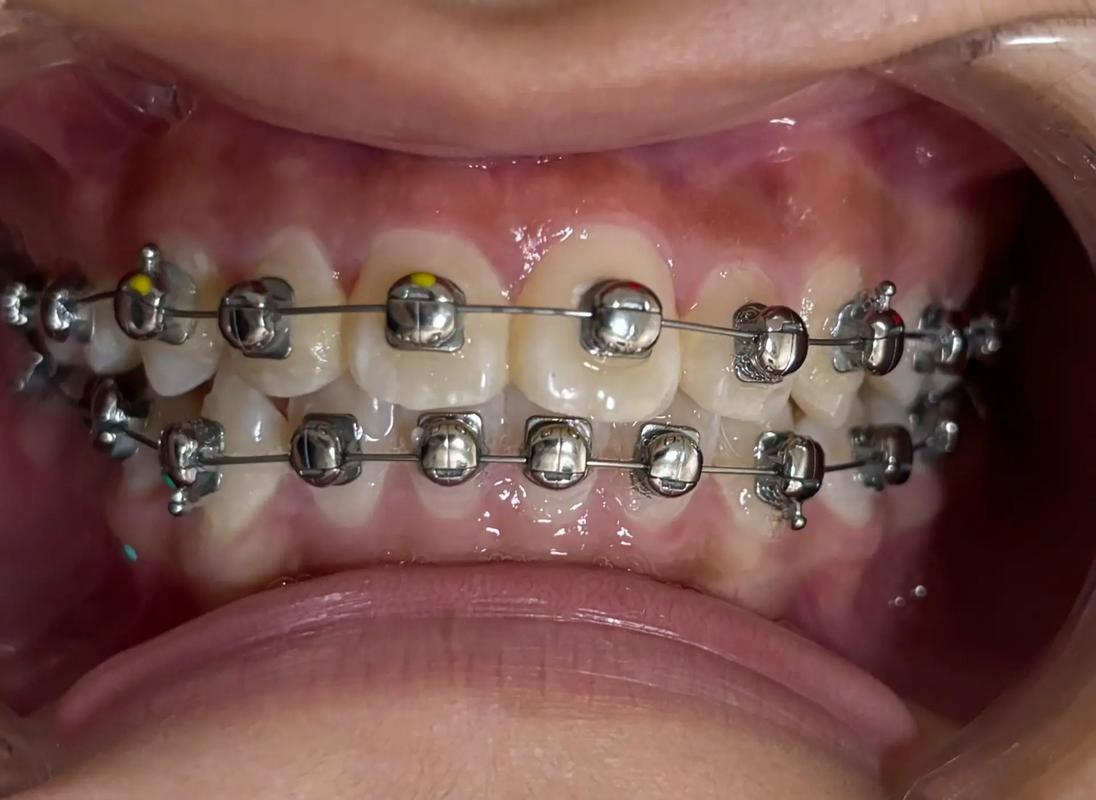 牙齿矫正 新西兰-图1 牙齿矫正 新西兰-图1