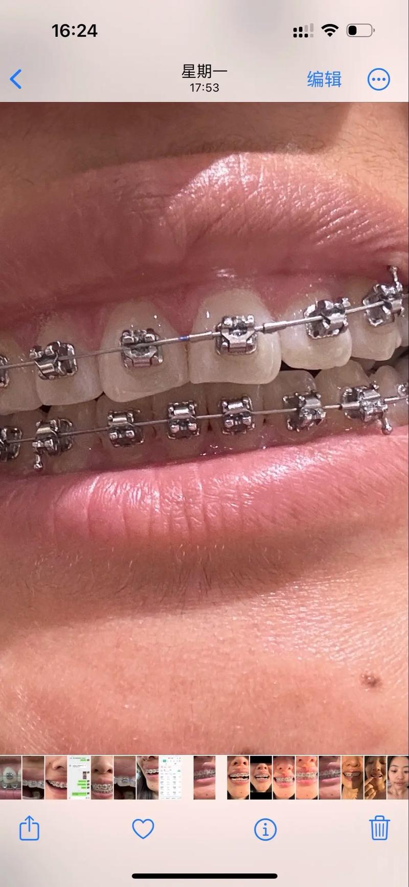 牙齿矫正 新西兰-图3