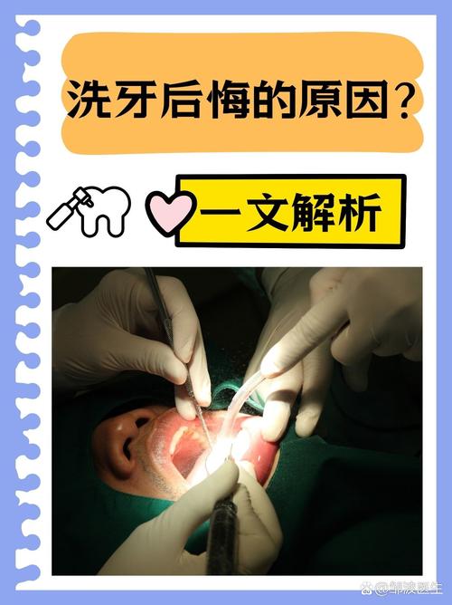 牙齿矫正前，洗牙是必须的吗？-图2