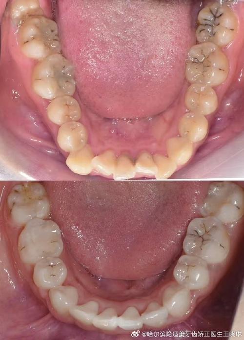 矫正为何要拔四颗牙？是必须还是过度？风险如何？-图3