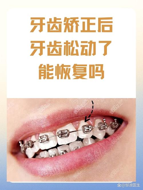 矫正期间牙齿松动正常吗？会自行恢复吗？-图3