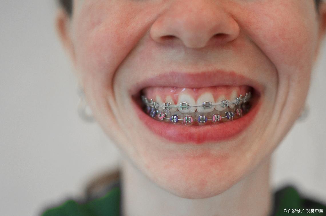 牙齿矫正真的会导致掉牙吗？-图2