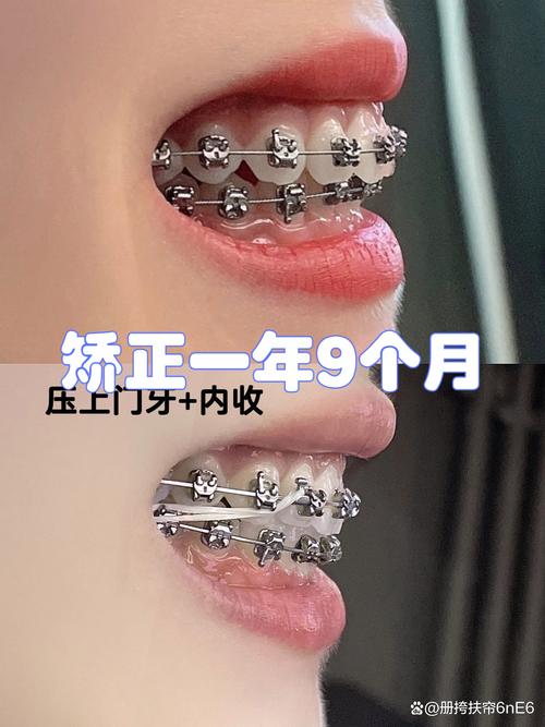 矫正完牙齿长智齿，会影响矫正效果吗？-图2