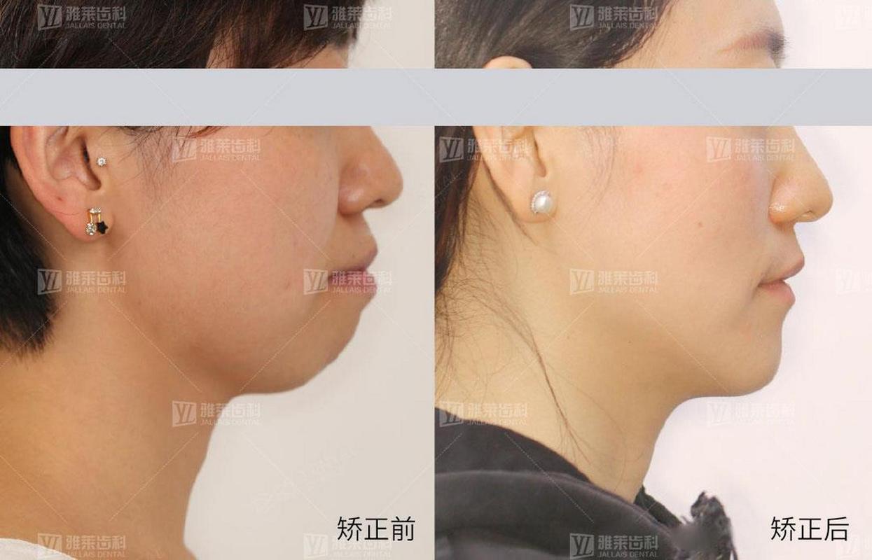 牙齿矫正侧面对比,侧脸改善效果差异明显吗?-图1 牙齿矫正侧面对比,侧脸改善效果差异明显吗?-图1