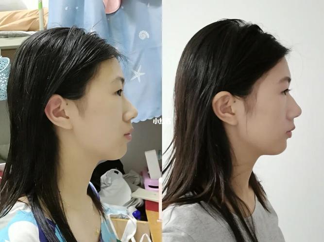 牙齿矫正侧面对比,侧脸改善效果差异明显吗?-图2 牙齿矫正侧面对比,侧脸改善效果差异明显吗?-图2