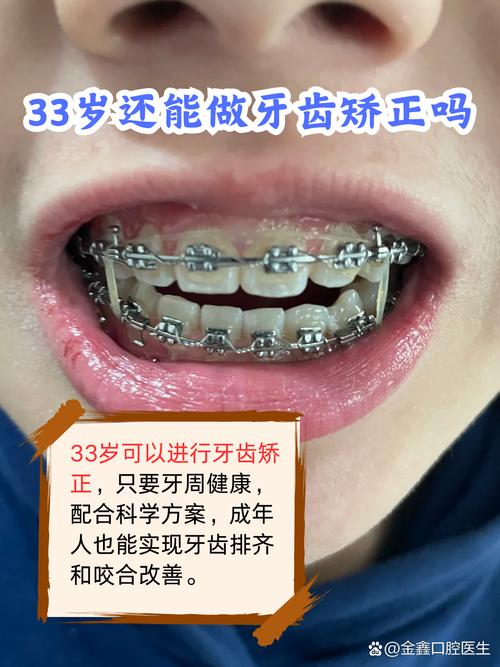 33岁做牙齿矫正,现在开始会不会太晚?效果和年轻人一样吗?-图2 33岁做牙齿矫正,现在开始会不会太晚?效果和年轻人一样吗?-图2