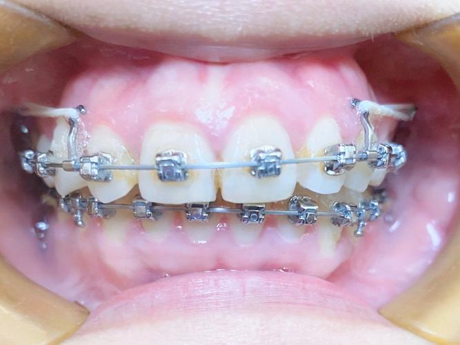 矫正牙齿用的托槽，有哪些常见类型？不同材质有何优缺点？怎么选？-图3