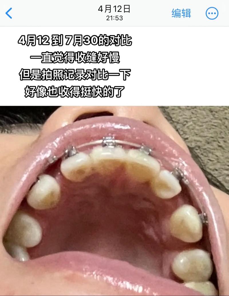 矫正牙齿收缝阶段有哪些注意事项?-图2 矫正牙齿收缝阶段有哪些注意事项?-图2