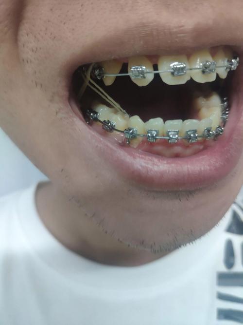 22岁矫正牙齿,这个年龄还来得及吗?效果怎么样?-图1 22岁矫正牙齿,这个年龄还来得及吗?效果怎么样?-图1