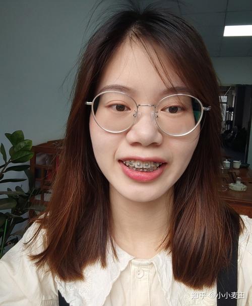 22岁矫正牙齿,这个年龄还来得及吗?效果怎么样?-图2 22岁矫正牙齿,这个年龄还来得及吗?效果怎么样?-图2