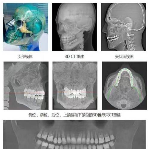 牙齿矫正为何要做头颅侧位？它对矫正方案有何关键意义？-图2