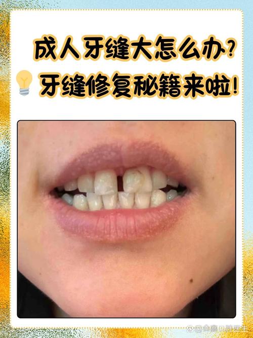 矫正牙齿后为何留缝隙?原因与处理方法-图3 矫正牙齿后为何留缝隙?原因与处理方法-图3