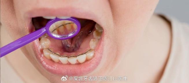 深圳矫正牙齿哪家好？求推荐靠谱医院诊所！-图2