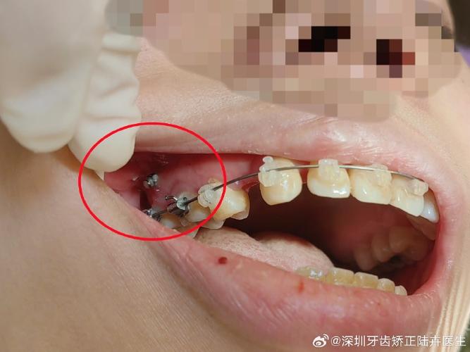 深圳矫正牙齿哪家好？求推荐靠谱医院诊所！-图3