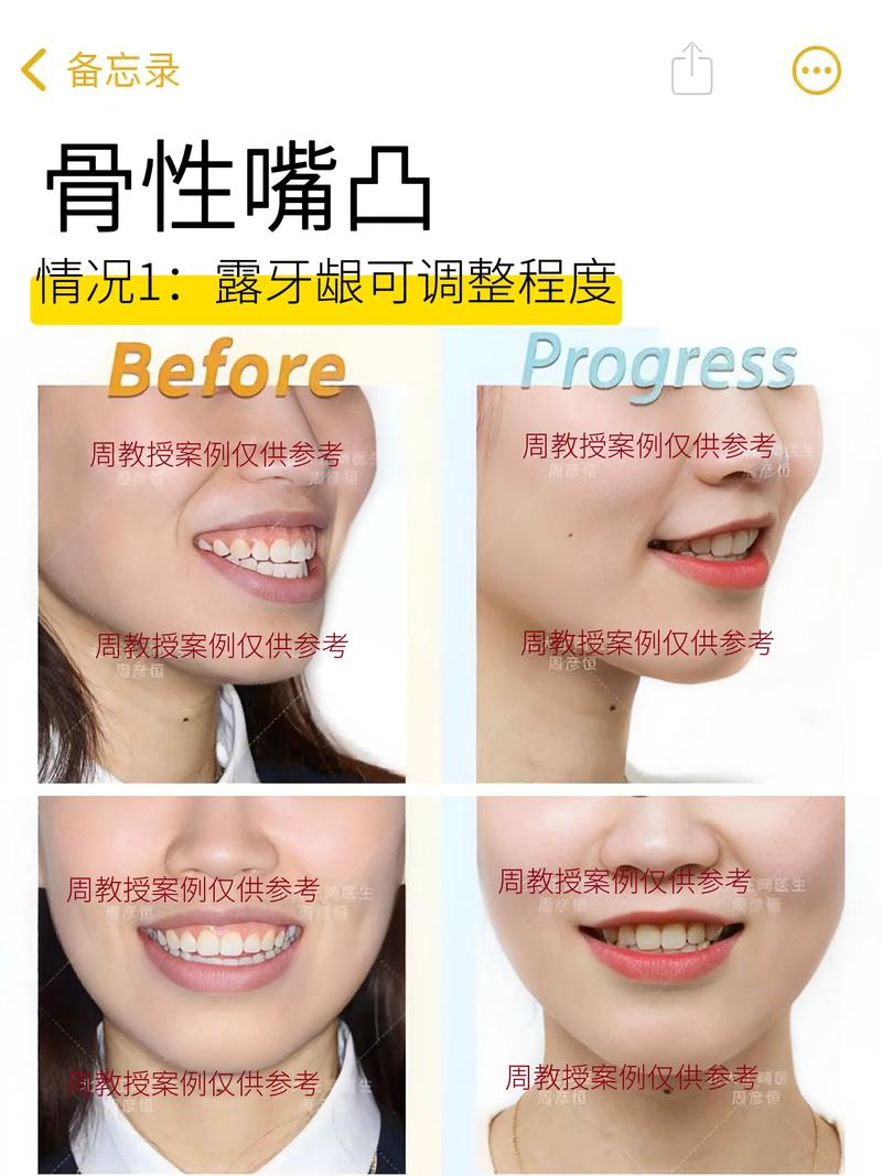 牙齿咬合关系矫正，哪些情况需做？效果如何？-图1