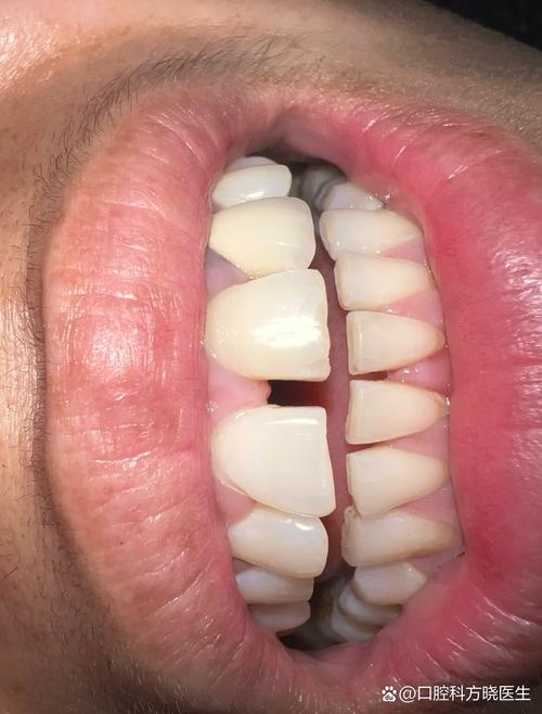 矫正牙齿后出现缝隙是正常现象吗?-图1 矫正牙齿后出现缝隙是正常现象吗?-图1