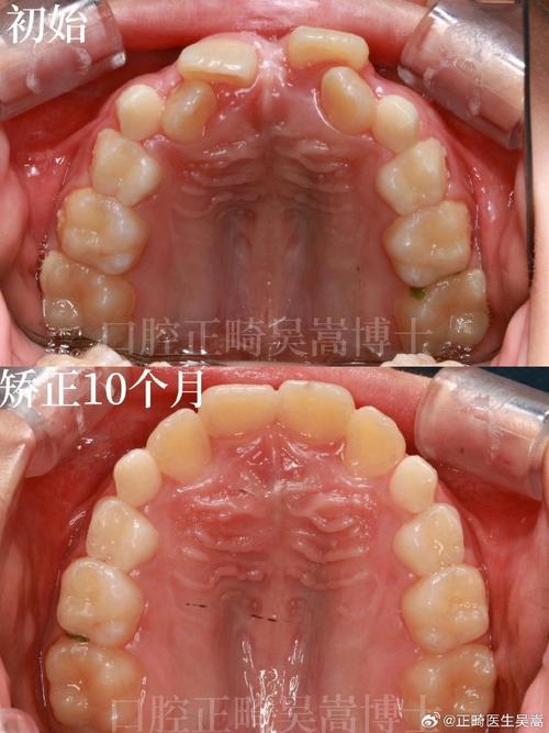 矫正牙齿后出现缝隙是正常现象吗？-图2