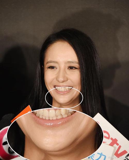 明星矫正牙齿图片为何频引关注？矫正效果有何不同？-图3