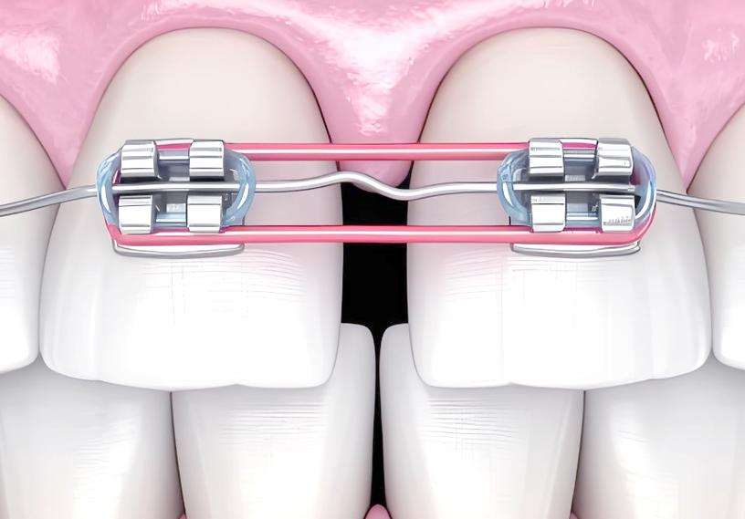 牙齿矫正拉橡皮筋，到底有什么用？怎么拉才有效？-图1