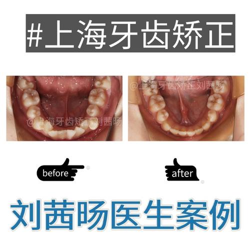 虎牙牙齿矫正价格-图2